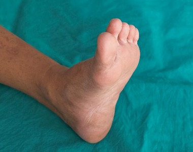 Ischemická choroba dolních končetin a syndrom diabetické nohy